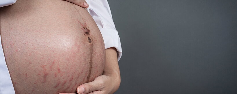 Striák szülés után: eltűnnek valaha, vagy örökre maradnak?